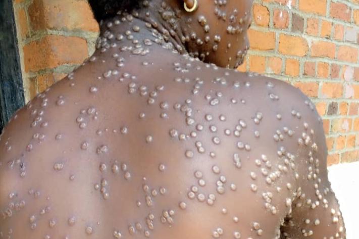 Santé : L’engagement du personnel éducatif pour la prévention du MPOX dans les écoles du Sud-Kivu